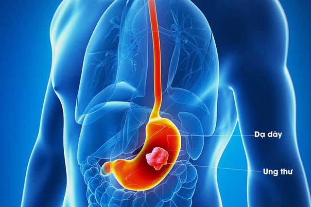 Ung thư dạ dày là nguyên nhân gây tử vong phổ biến thứ 2 ở cả nam và nữ