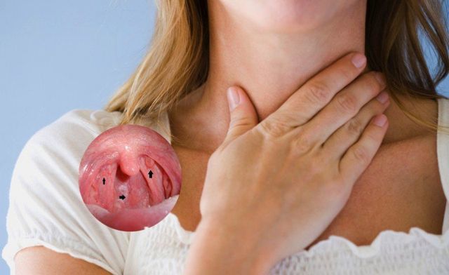 Ung thư vòm họng nếu phát hiện sớm vẫn có phương pháp điều trị hiệu quả