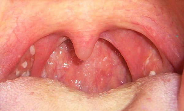 Rõ ràng hình ảnh ung thư vòm họng giai đoạn cuối đối với sức khỏe con người