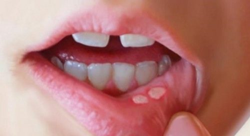 Loét miệng và họng là những tác dụng phụ khi hóa trị