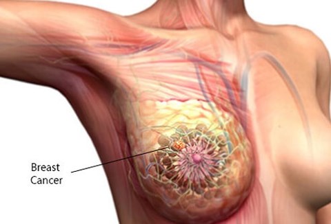 Hình ảnh khối u ở vú