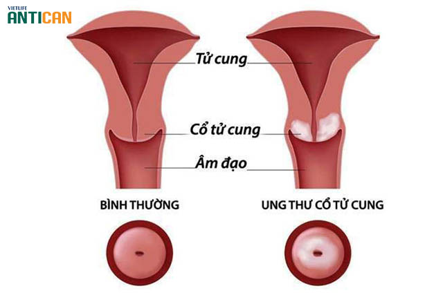 Hình ảnh ung thư cổ tử cung