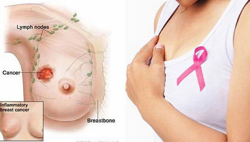 8 dấu hiệu ung thư vú mọi người nên chú ý