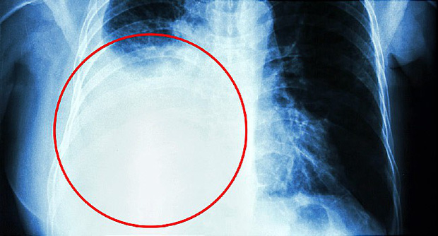 Ung thư vú di căn qua phổi gây tràn dịch màng phổi