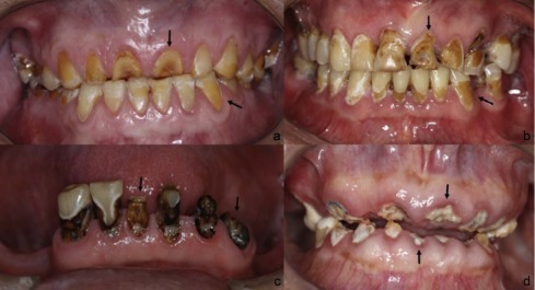Tác dụng phụ trên răng miệng ở bệnh nhân xạ trị